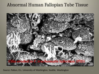 Abnormal Human Fallopian Tube Tissue
Cilia eroded in C. trachomatis Infection (PID)
Source: Patton, D.L. University of Washington, Seattle, Washington 23
 