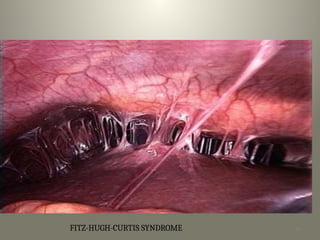 FITZ-HUGH-CURTIS SYNDROME 12
ECTOPIC
INFERTIL- PREGNANCY
ITY
 