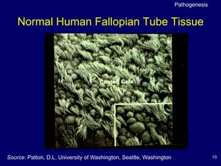 10
Normal Human Fallopian Tube Tissue
Source: Patton, D.L. University of Washington, Seattle, Washington
Pathogenesis
 