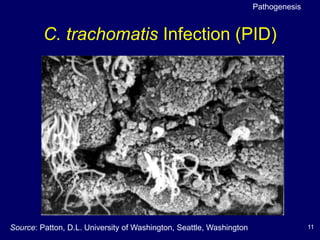 11
C. trachomatis Infection (PID)
Source: Patton, D.L. University of Washington, Seattle, Washington
Pathogenesis
 