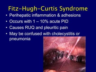 Fitz-Hugh-Curtis Syndrome
• Perihepatic inflammation & adhesions
• Occurs with 1 – 10% acute PID
• Causes RUQ and pleuritic pain
• May be confused with cholecystitis or
pneumonia
 