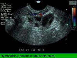 Hydrosalpinx (anechoic tubular structure)
 
