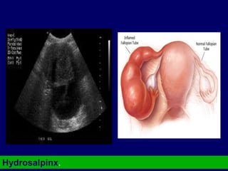 Hydrosalpinx.
 