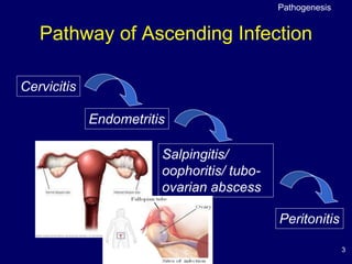 3
Pathway of Ascending Infection
Cervicitis
Endometritis
Salpingitis/
oophoritis/ tubo-
ovarian abscess
Peritonitis
Pathogenesis
 