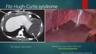 String. Sign Fitz Pelvic Inflammatory Disease with YouTube Video | PPTX