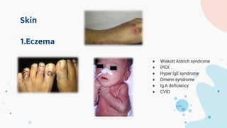 Skin
● Wiskott Aldrich syndrome
● IPEX
● Hyper IgE syndrome
● Omenn syndrome
● Ig A deficiency
● CVID
1.Eczema
 