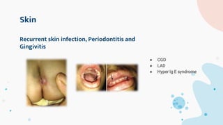 Skin
● CGD
● LAD
● Hyper Ig E syndrome
Recurrent skin infection, Periodontitis and
Gingivitis
 