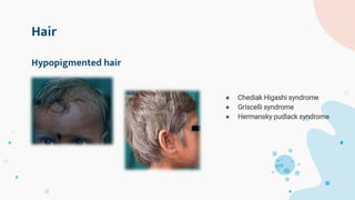 Hair
● Chediak Higashi syndrome
● Griscelli syndrome
● Hermansky pudlack syndrome
Hypopigmented hair
 