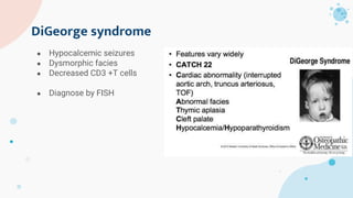 DiGeorge syndrome
● Hypocalcemic seizures
● Dysmorphic facies
● Decreased CD3 +T cells
● Diagnose by FISH
 