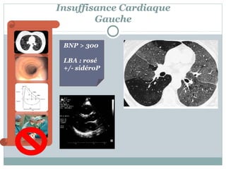 Insuffisance Cardiaque
Gauche
BNP > 300
LBA : rosé
+/- sidéroP

 