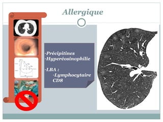 Allergique

-Précipitines
-Hyperéosinophilie
-LBA :
-Lymphocytaire
CD8

 