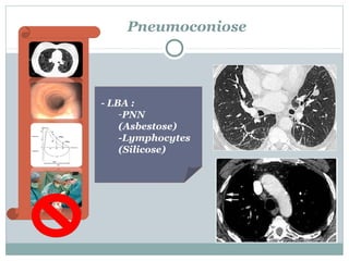 Pneumoconiose

- LBA :
-PNN
(Asbestose)
-Lymphocytes
(Silicose)

 