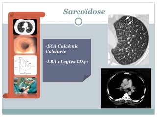 Sarcoïdose

-ECA Calcémie
Calciurie
-LBA : Lcytes CD4+

 