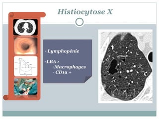 Histiocytose X

- Lymphopénie
-LBA :
-Macrophages
- CD1a +

 