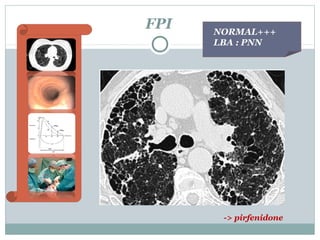 FPI

NORMAL+++
LBA : PNN

-> pirfenidone

 