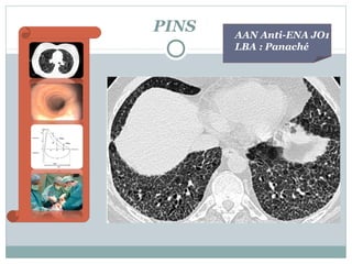 PINS

AAN Anti-ENA JO1
LBA : Panaché

 