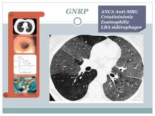 GNRP

ANCA Anti-MBG
Créatininémie
Eosinophilie
LBA sidérophages

 