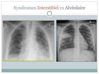Syndromes Interstitiel vs Alvéolaire

 