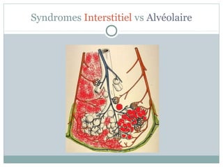 Syndromes Interstitiel vs Alvéolaire

 