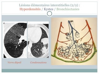 Lésions élémentaires interstitielles (2/2) :
Hyperdensités / Kystes / Bronchiectasies

Verre dépoli

Condensations

Kystes

Rayon de miel

 