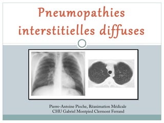 Pneumopathies
interstitielles diffuses

Pierre-Antoine Pioche, Réanimation Médicale
CHU Gabriel Montpied Clermont Ferrand

 