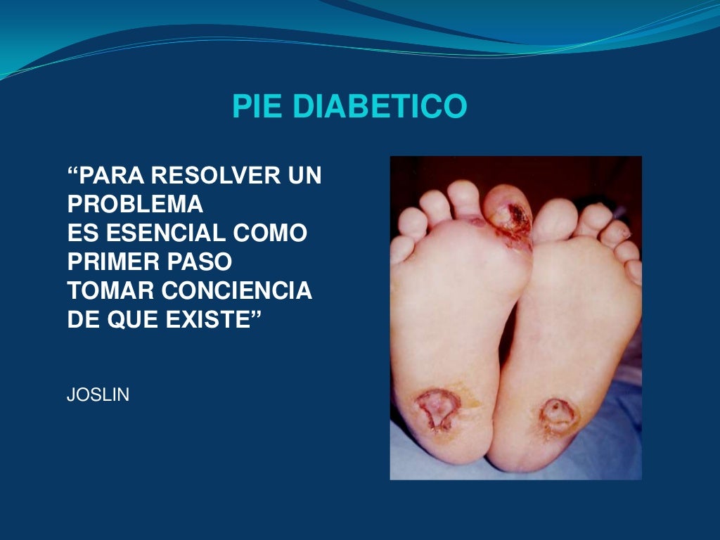 Tratamiento actual del pie diabetico