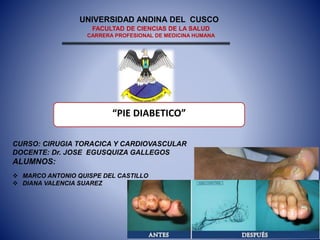 “PIE DIABETICO”
UNIVERSIDAD ANDINA DEL CUSCO
FACULTAD DE CIENCIAS DE LA SALUD
CARRERA PROFESIONAL DE MEDICINA HUMANA
CURSO: CIRUGIA TORACICA Y CARDIOVASCULAR
DOCENTE: Dr. JOSE EGUSQUIZA GALLEGOS
ALUMNOS:
 MARCO ANTONIO QUISPE DEL CASTILLO
 DIANA VALENCIA SUAREZ
 