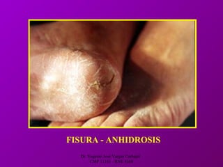 Dr. Eugenio José Vargas Carbajal
CMP 11161 - RNE 4368
FISURA - ANHIDROSIS
 