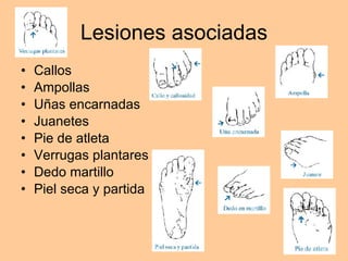 Lesiones asociadas Callos Ampollas Uñas encarnadas Juanetes Pie de atleta Verrugas plantares Dedo martillo Piel seca y partida 