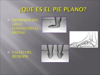 DEPRESION DEL ARCO LONGITUDINAL MEDIAL VALGO DEL RETROPIE