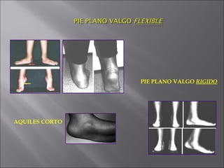 PIE PLANO VALGO RIGIDO AQUILES CORTO