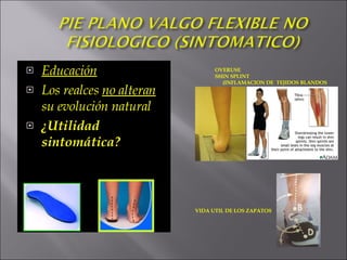 Educación Los realces no alteran su evolución natural ¿Utilidad sintomática? OVERUSE SHIN SPLINT (INFLAMACION DE TEJIDOS BLANDOS VIDA UTIL DE LOS ZAPATOS