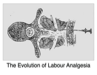 The Evolution of Labour Analgesia
 