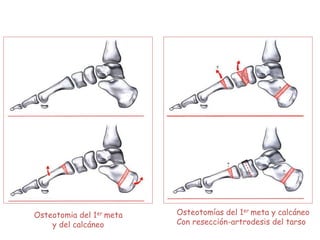 Osteotomia del 1er meta
y del calcáneo
Osteotomías del 1er meta y calcáneo
Con resección-artrodesis del tarso
 