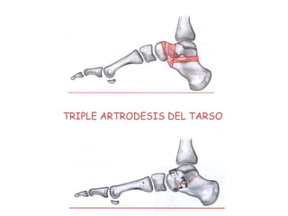 TRIPLE ARTRODESIS DEL TARSO
 