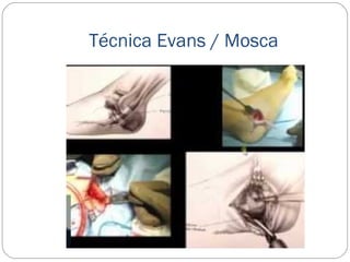 Técnica Evans / Mosca
 