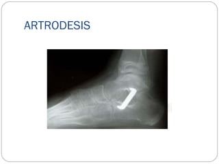 ARTRODESIS
 