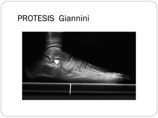 PROTESIS  Giannini
 