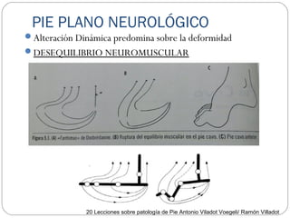 PIE PLANO NEUROLÓGICO
Alteración Dinámica predomina sobre la deformidad
DESEQUILIBRIO NEUROMUSCULAR
20 Lecciones sobre patología de Pie Antonio Viladot Voegeli/ Ramón Villadot
 