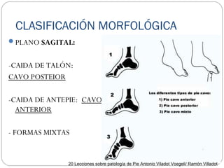 CLASIFICACIÓN MORFOLÓGICA
PLANO SAGITAL:
-CAIDA DE TALÓN:
CAVO POSTEIOR
-CAIDA DE ANTEPIE: CAVO
ANTERIOR
- FORMAS MIXTAS
20 Lecciones sobre patología de Pie Antonio Viladot Voegeli/ Ramón Villadot
 