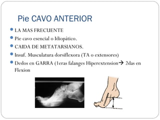Pie CAVO ANTERIOR
LA MAS FRECUENTE
Pie cavo esencial o Idiopático.
CAIDA DE METATARSIANOS.
Insuf. Musculatura dorsiflexora (TA o extensores)
Dedos en GARRA (1eras falanges Hiperextension 2das en
Flexion
 