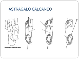 ASTRAGALO CALCANEO
 