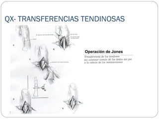 QX- TRANSFERENCIAS TENDINOSAS
Operación de Jones
 