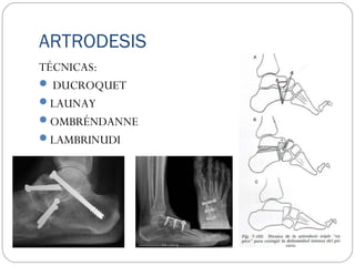 ARTRODESIS
TÉCNICAS:
 DUCROQUET
LAUNAY
OMBRÉNDANNE
LAMBRINUDI
 