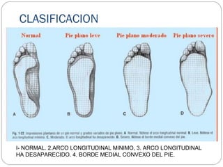 CLASIFICACION
I- NORMAL. 2.ARCO LONGITUDINAL MINIMO, 3. ARCO LONGITUDINAL
HA DESAPARECIDO. 4. BORDE MEDIAL CONVEXO DEL PIE.
 