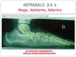 ASTRAGALO 3-A´s
Abajo, Adelante, Adentro
ALTERACION FUNDAMENTAL
ARTICULACION SUBASTRAGALINA
 