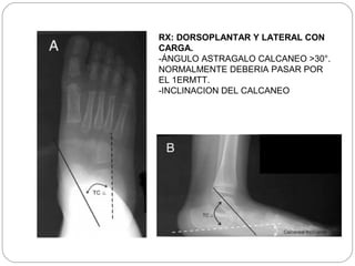 RX: DORSOPLANTAR Y LATERAL CON
CARGA.
-ÁNGULO ASTRAGALO CALCANEO >30°.
NORMALMENTE DEBERIA PASAR POR
EL 1ERMTT.
-INCLINACION DEL CALCANEO
 