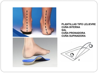 PLANTILLAS TIPO LELIEVRE
CUÑA INTERNA
SAL
CUÑA PRONADORA
CUÑA SUPINADORA
 