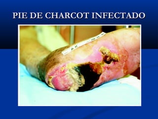 PIE DE CHARCOT INFECTADOPIE DE CHARCOT INFECTADO
 