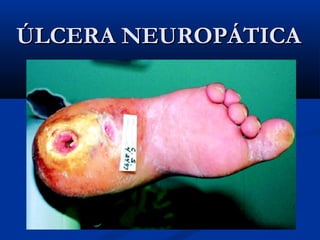 ÚLCERA NEUROPÁTICAÚLCERA NEUROPÁTICA
 